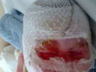 Недалеко от Новочеркасска  в поселке Казачьи Лагери маленькая девочка обварила себе лицо кипятком