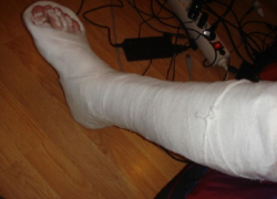 Покалеченную ногу пострадавшего в страшном ДТП парня ампутировали в Новочеркасске