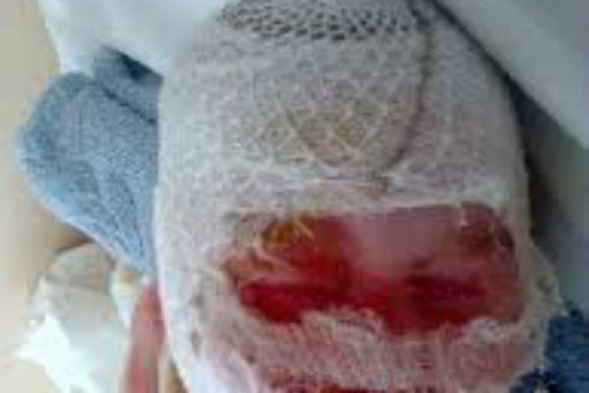 Недалеко от Новочеркасска  в поселке Казачьи Лагери маленькая девочка обварила себе лицо кипятком